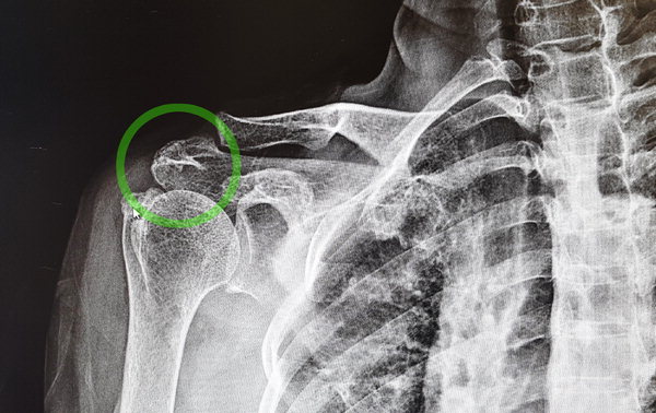 ▲ (그림1) 어깨부위 엑스레이 사진으로 동그라미 속 어깨뼈를 보면 하얗게 된 부분이 있는데, 이는 근육이 어깨뼈를 자극해 웃자란 뼈의 모습이다. /서울병원