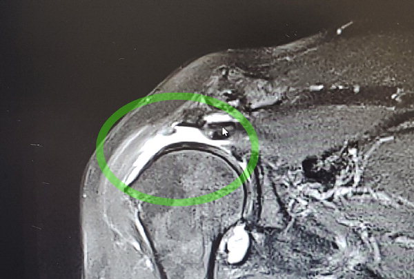 ▲ (그림2) CT사진에서 어깨부위에 하얗게 되어 있는 부분은 근육이 떨어져 오른쪽으로 당겨 들어가는 바람에 비어진 공간이다. /서울병원
