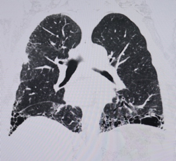 ▲ 섬유화가 많이 진행된 상태의 폐 CT사진으로 왼쪽 윗부분의 동그랗게 패인 부분은 암이 발생한 곳.